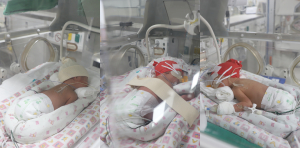 계명대 동산병원서 세쌍둥이 탄생
