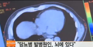 당뇨병 발병에 핵심적 역할‘뇌’