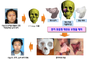 3D프린터로 함몰된 광대뼈 완벽 재생